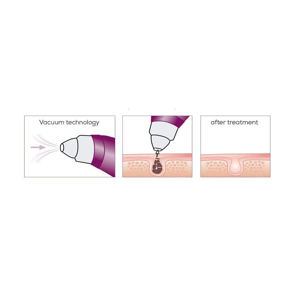 Beurer Deep Pore Cleaner And Vacuum Blackhead Removal - Purple/White