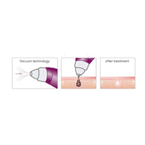 Beurer Deep Pore Cleaner And Vacuum Blackhead Removal - Purple/White